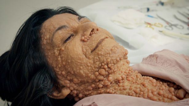 badan penuh biji macam buih, ibu ini tak malu dengan diri sendiri